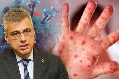 BAKAN MEMİŞOĞLU’NDAN MAYMUN ÇİÇEĞİ VİRÜSÜ AÇIKLAMASI: “ŞU ANA KADAR TANISI KONULMUŞ BİR HASTAMIZ, HASTALIĞIMIZ YOK"